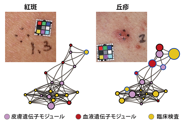 皮膚症状で異なる遺伝子発現パターンの図