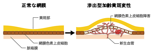 滲出型加齢黄斑変性の図