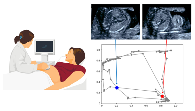 グラフチャート図を用いた超音波画像診断支援の図