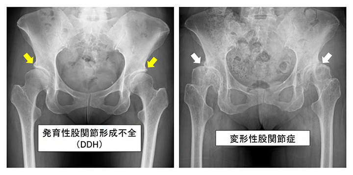 発育性股関節形成不全（DDH）および変形性股関節症（OA）の画像所見の図