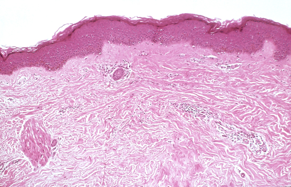 image of skin affected by systemic sclerosis