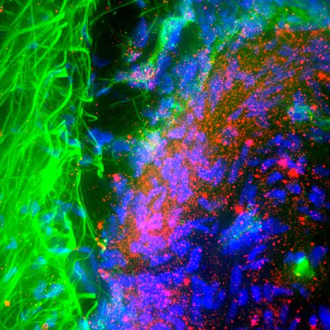 image of a section of brain affected by Parkinson’s disease