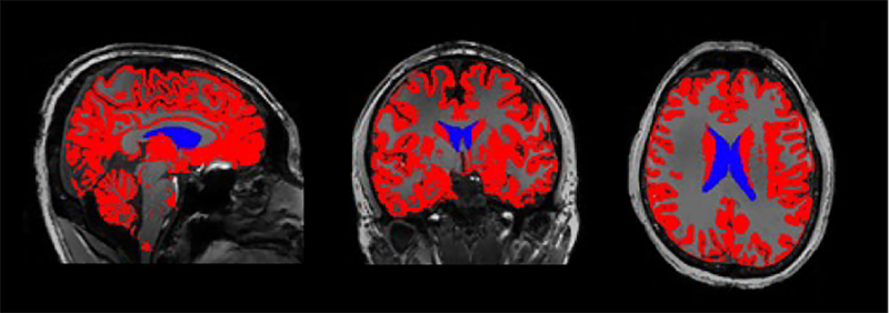 image of brain MRI