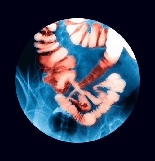 image of inflammatory bowel disease